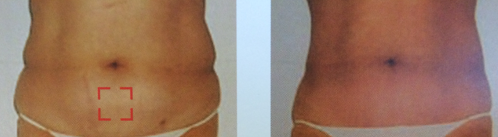 cryolipolyse 3